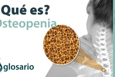 Osteopenia Tratamiento: Mejorando tu Salud Ósea
