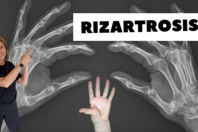 Manejo y Tratamiento Efectivo para la Rizoartrosis